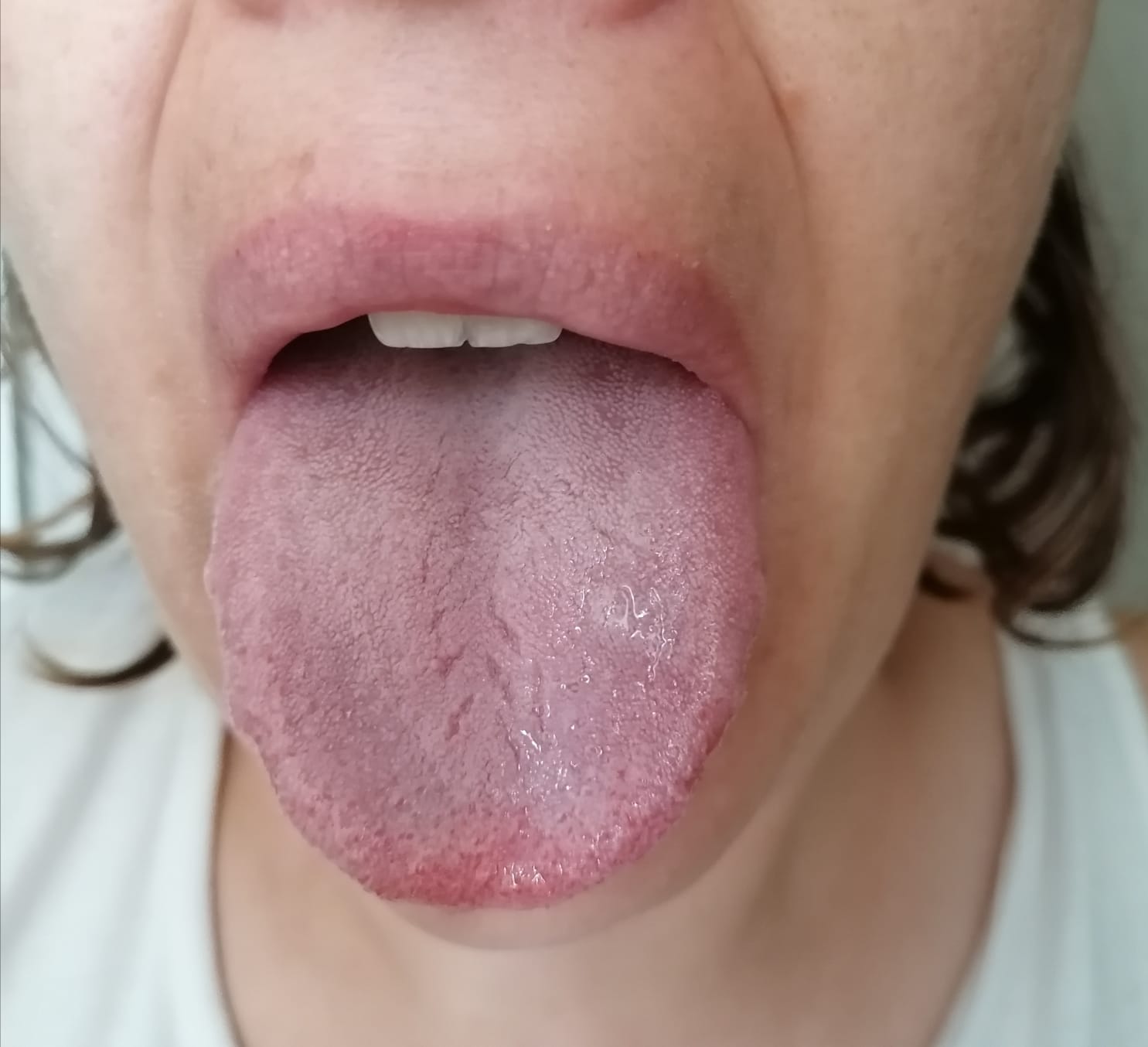 Podcast: Un Caso de Dolor Cervical